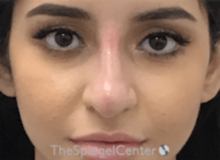 Non-Surgical Rhinoplasty / Nose Filler Before & After Gallery - Patient 157140687 - Image 2