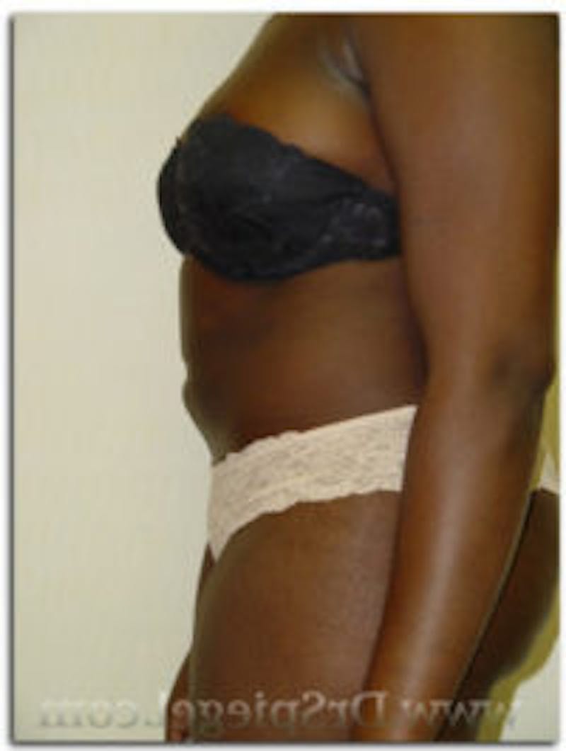 Liposuction Before & After Gallery - Patient 157140681 - Image 2