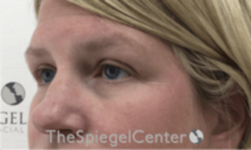 Tear Trough / Under Eye Fillers Before & After Gallery - Patient 677561 - Image 3