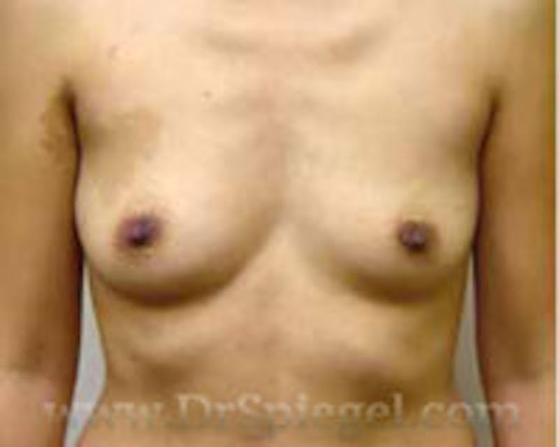 Breast Augmentation Before & After Gallery - Patient 157140685 - Image 1