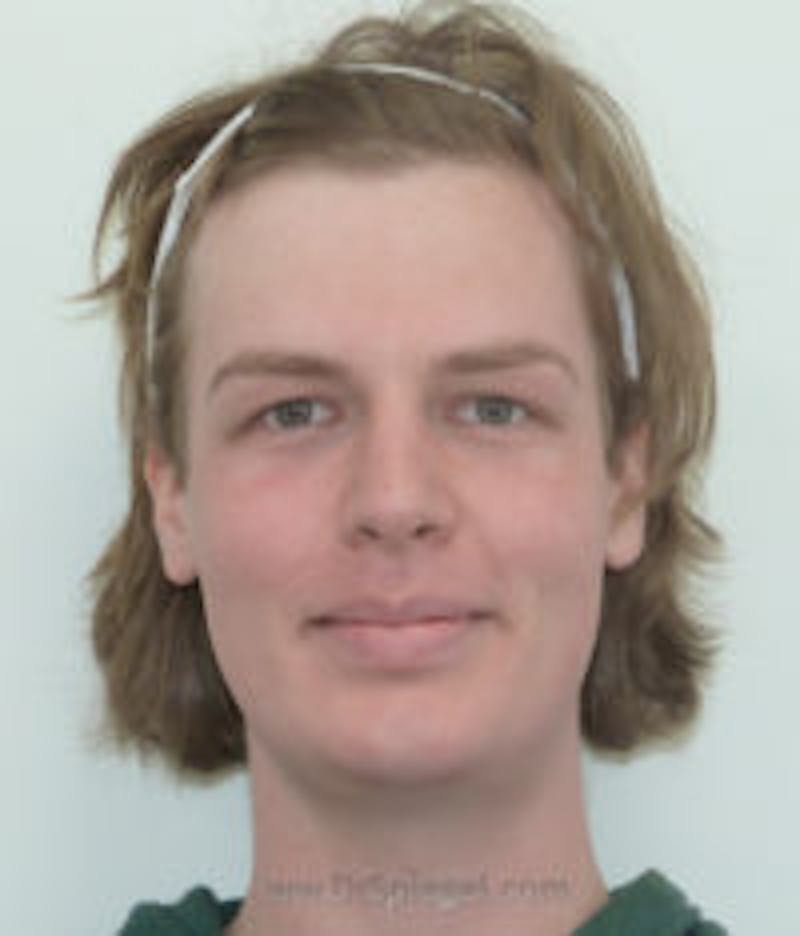 FFS Before & After Gallery - Patient 157140686 - Image 1