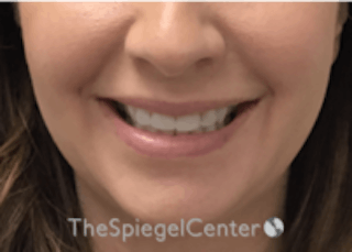 Lip Filler Before & After Gallery - Patient 157140695 - Image 2