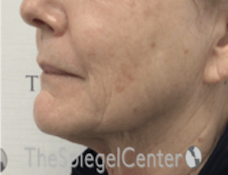 Nasolabial Fold Filler Before & After Gallery - Patient 157140683 - Image 4