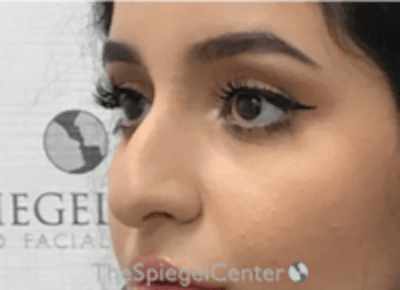 Non-Surgical Rhinoplasty / Nose Filler Before & After Gallery - Patient 157140687 - Image 3