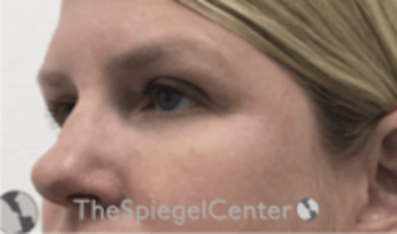 Tear Trough / Under Eye Fillers Before & After Gallery - Patient 677561 - Image 4