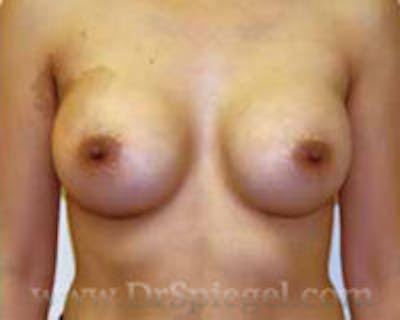 Breast Augmentation Before & After Gallery - Patient 157140685 - Image 2
