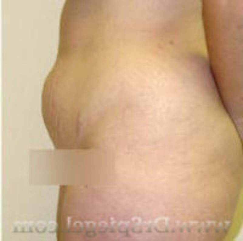 Liposuction Before & After Gallery - Patient 157140689 - Image 1