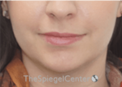 Lip Filler Before & After Gallery - Patient 157140695 - Image 3