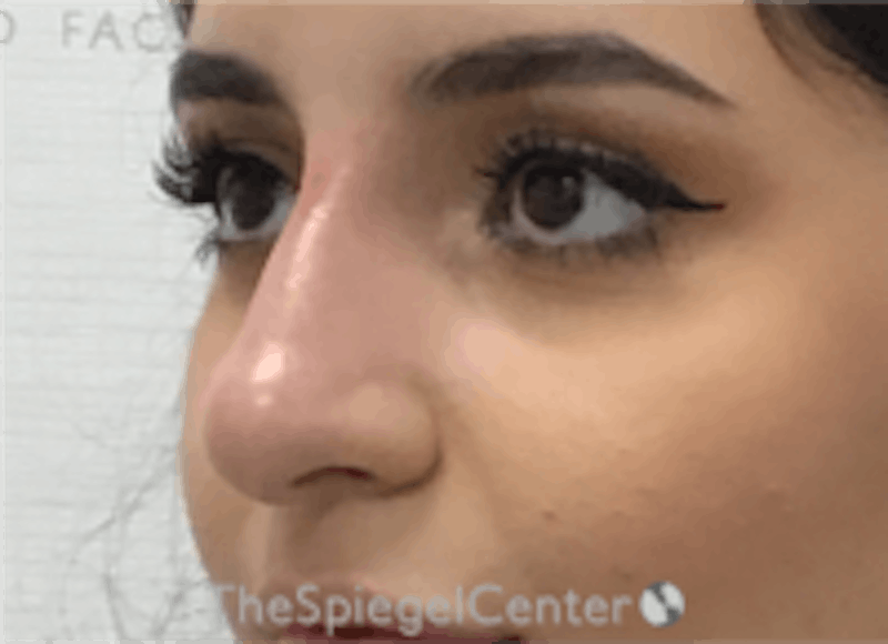 Non-Surgical Rhinoplasty / Nose Filler Before & After Gallery - Patient 157140687 - Image 4