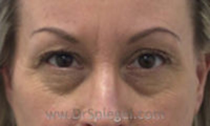 Temple Filler Before & After Gallery - Patient 157140691 - Image 1