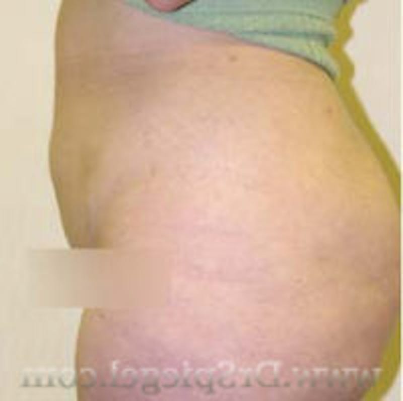 Liposuction Before & After Gallery - Patient 157140689 - Image 2