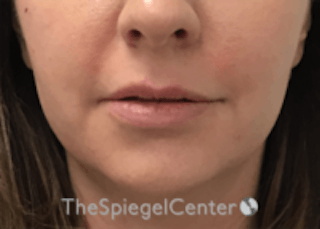 Lip Filler Before & After Gallery - Patient 157140695 - Image 4