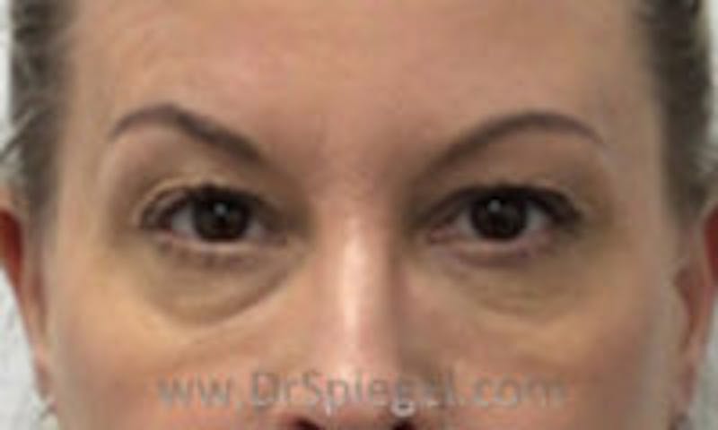 Temple Filler Before & After Gallery - Patient 157140691 - Image 2