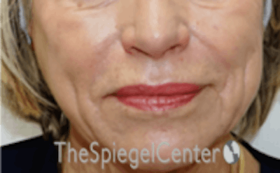 Nasolabial Fold Filler Before & After Gallery - Patient 157140701 - Image 1