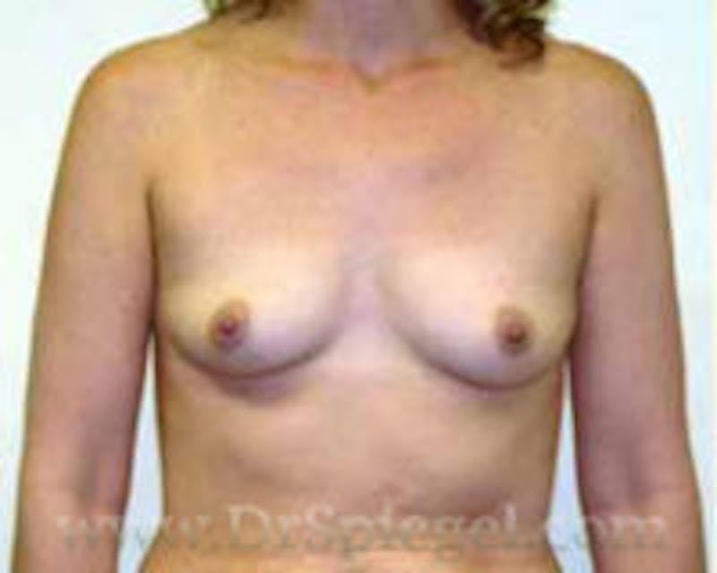 Breast Augmentation Before & After Gallery - Patient 157140693 - Image 1