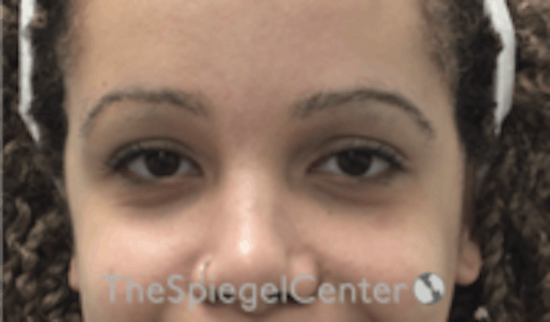 Tear Trough / Under Eye Fillers Before & After Gallery - Patient 157140700 - Image 1