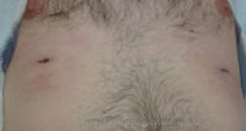 Extra Nipple Removal Before & After Gallery - Patient 157140692 - Image 2