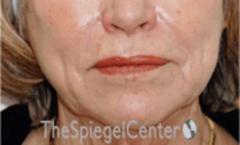 Nasolabial Fold Filler Before & After Gallery - Patient 157140701 - Image 2