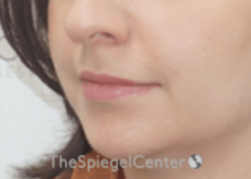 Lip Filler Before & After Gallery - Patient 157140695 - Image 5