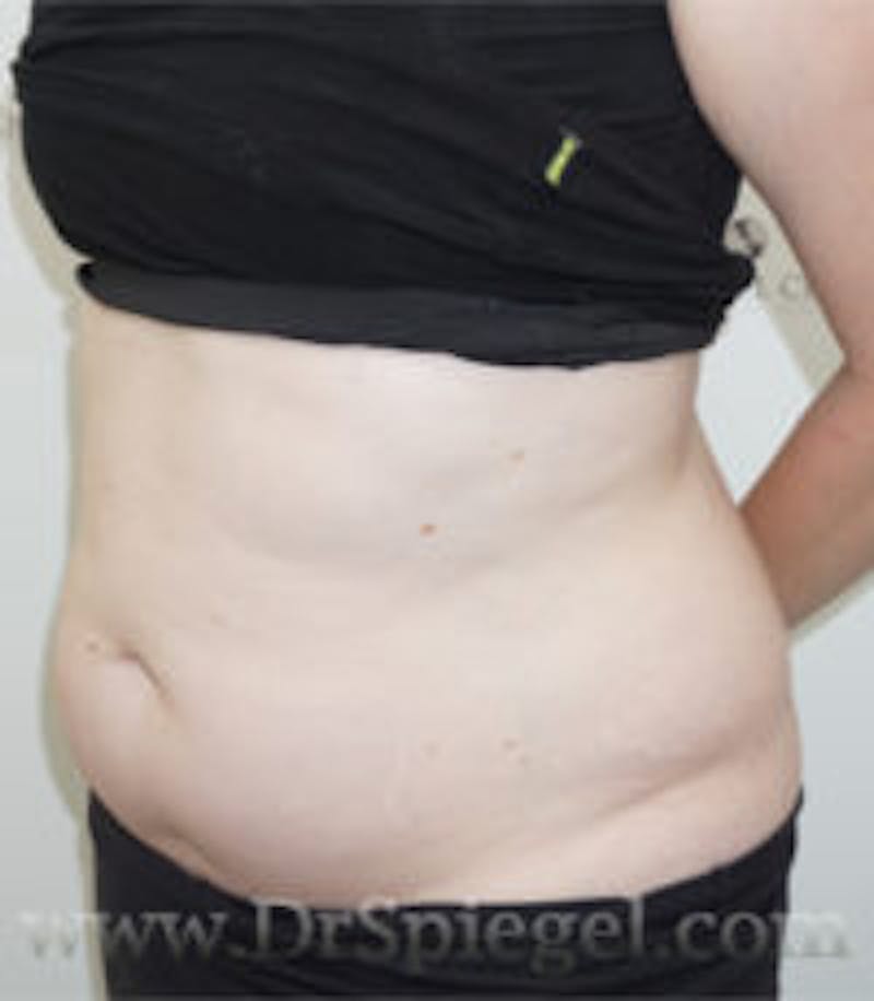 Liposuction Before & After Gallery - Patient 157140696 - Image 1