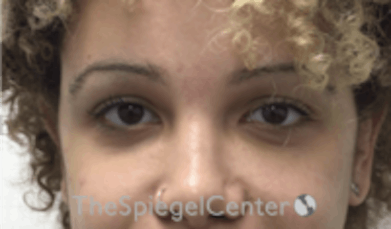 Tear Trough / Under Eye Fillers Before & After Gallery - Patient 157140700 - Image 2