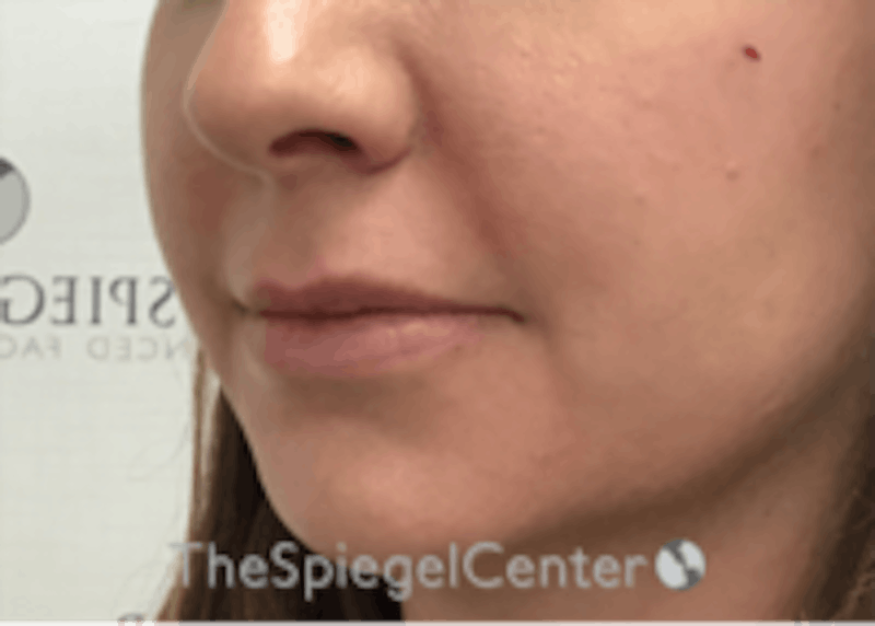Lip Filler Before & After Gallery - Patient 157140695 - Image 6