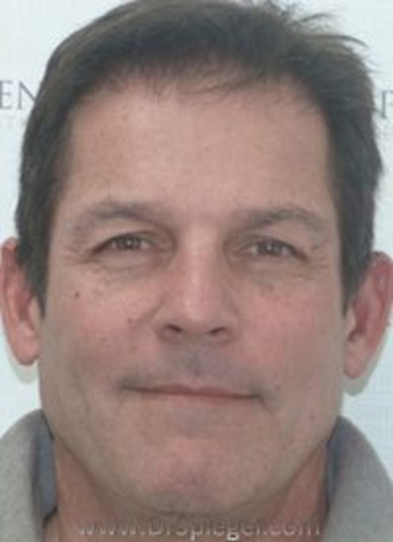 Botox / Dysport / Jeuveau / Xeomin Before & After Gallery - Patient 157140697 - Image 2