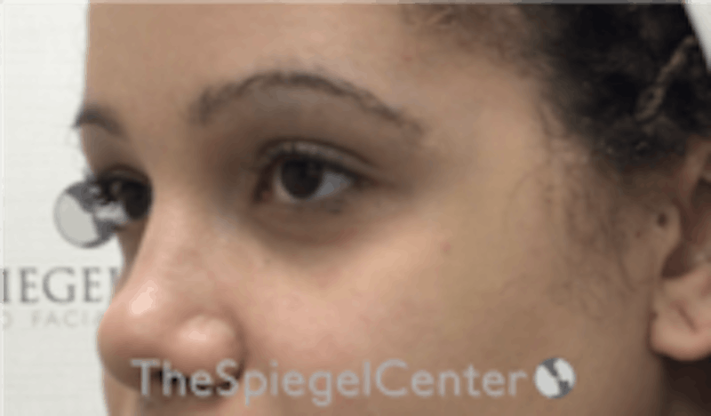 Tear Trough / Under Eye Fillers Before & After Gallery - Patient 157140700 - Image 3