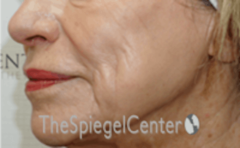Nasolabial Fold Filler Before & After Gallery - Patient 157140701 - Image 3