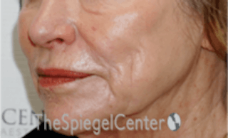Nasolabial Fold Filler Before & After Gallery - Patient 157140701 - Image 4