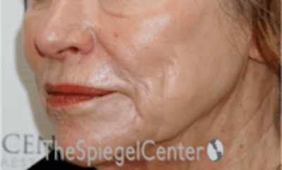 Nasolabial Fold Filler Before & After Gallery - Patient 157140701 - Image 4