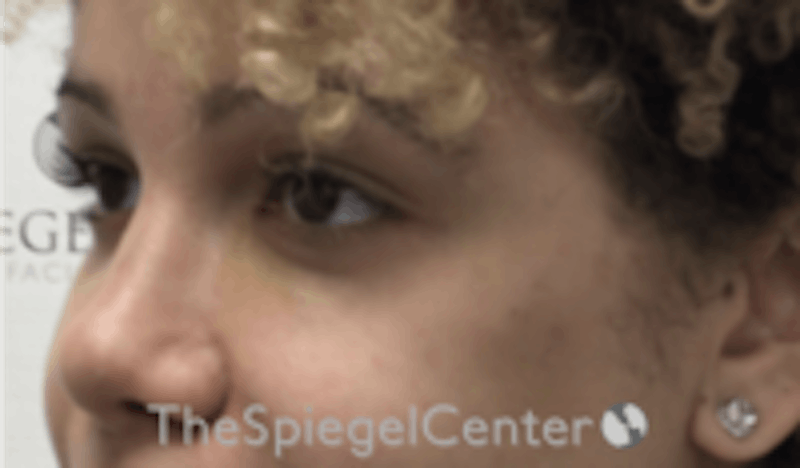 Tear Trough / Under Eye Fillers Before & After Gallery - Patient 157140700 - Image 4