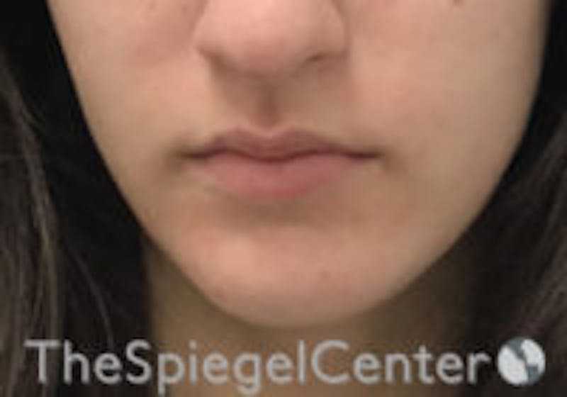 Lip Filler Before & After Gallery - Patient 157140711 - Image 1