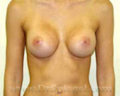 Breast Augmentation Before & After Gallery - Patient 157140703 - Image 2