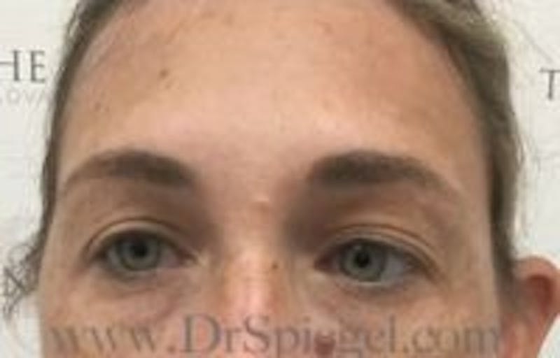 Temple Filler Before & After Gallery - Patient 157140707 - Image 1