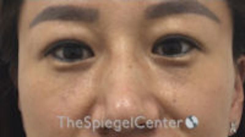 Tear Trough / Under Eye Fillers Before & After Gallery - Patient 157140714 - Image 1