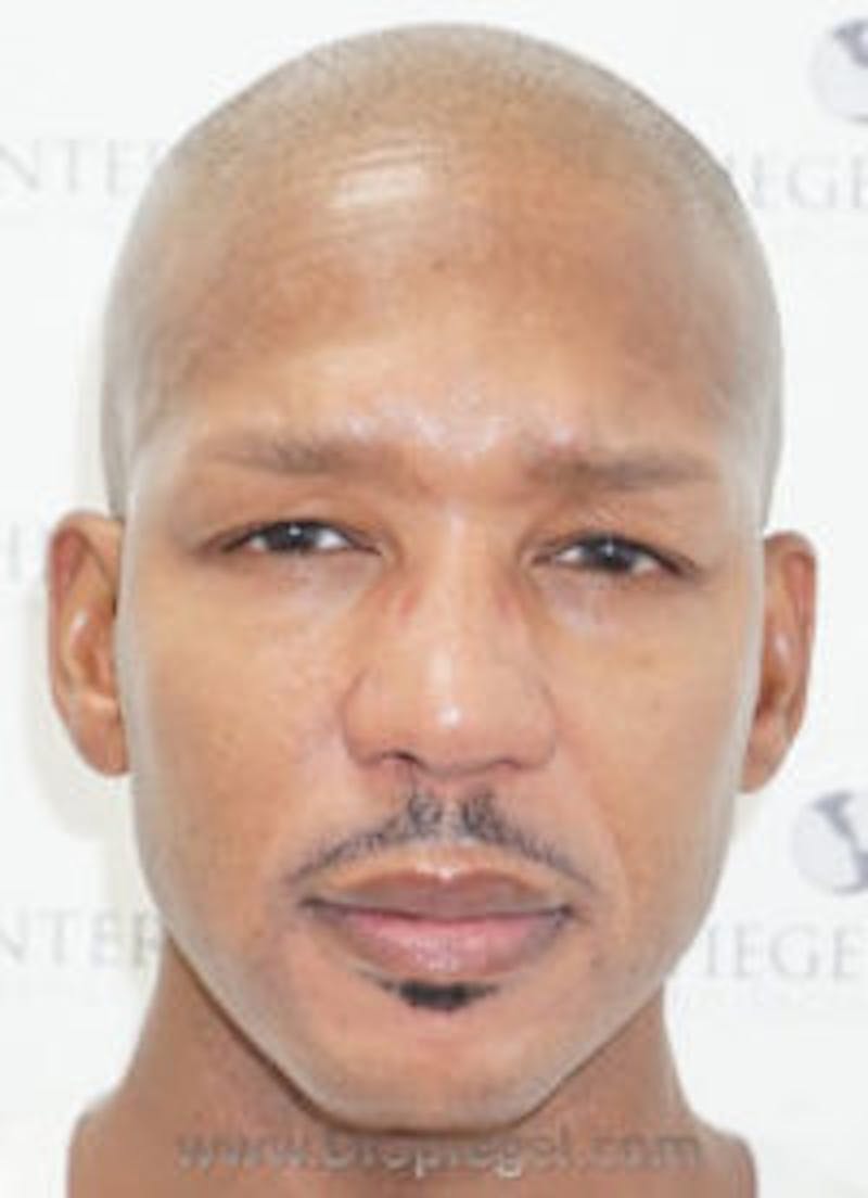 Botox / Dysport / Jeuveau / Xeomin Before & After Gallery - Patient 157140704 - Image 2