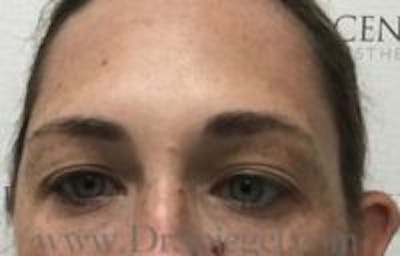 Temple Filler Before & After Gallery - Patient 157140707 - Image 2