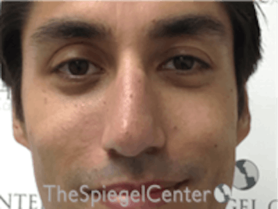 Non-Surgical Rhinoplasty / Nose Filler Before & After Gallery - Patient 157140720 - Image 1