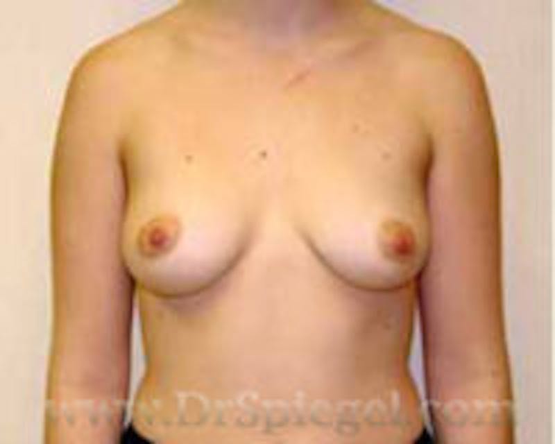 Breast Augmentation Before & After Gallery - Patient 157140712 - Image 1