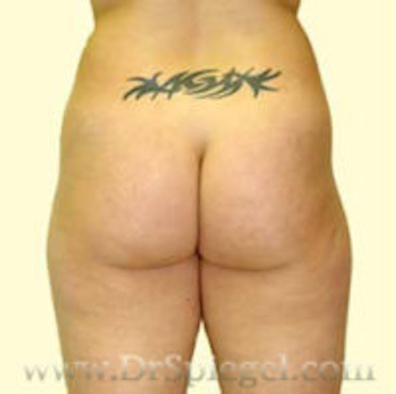 Liposuction Before & After Gallery - Patient 157140713 - Image 1