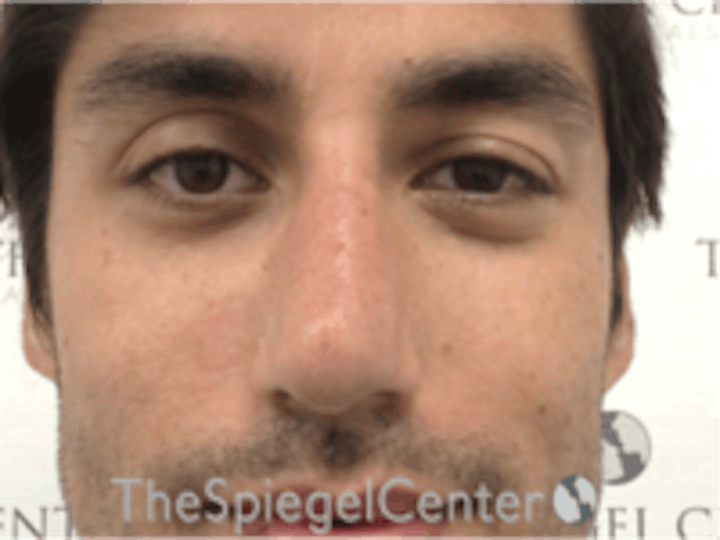 Non-Surgical Rhinoplasty / Nose Filler Before & After Gallery - Patient 157140720 - Image 2