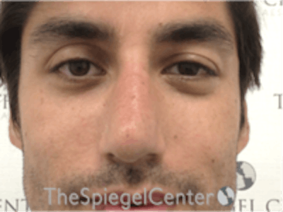 Non-Surgical Rhinoplasty / Nose Filler Before & After Gallery - Patient 157140720 - Image 2