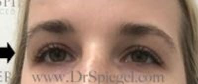 Temple Filler Before & After Gallery - Patient 157140715 - Image 1