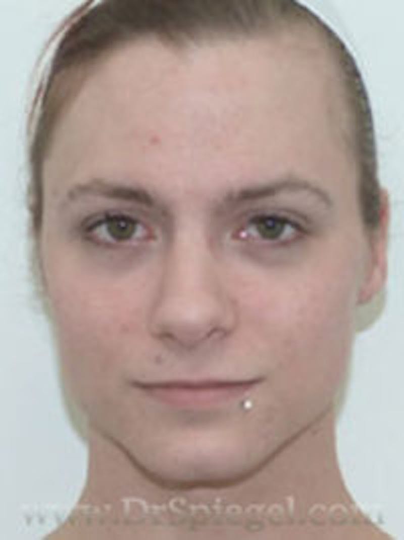 FFS Before & After Gallery - Patient 157140717 - Image 1
