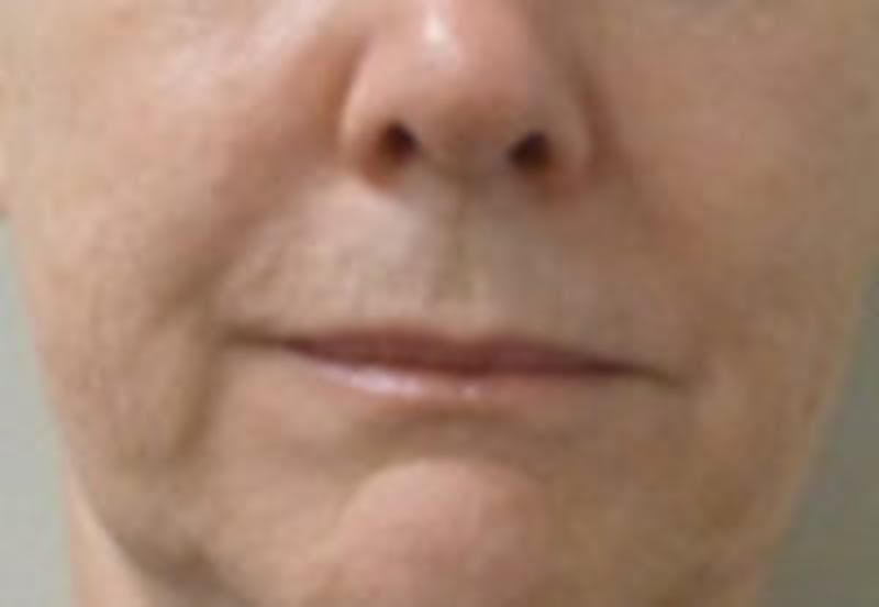 Nasolabial Fold Filler Before & After Gallery - Patient 157140718 - Image 1