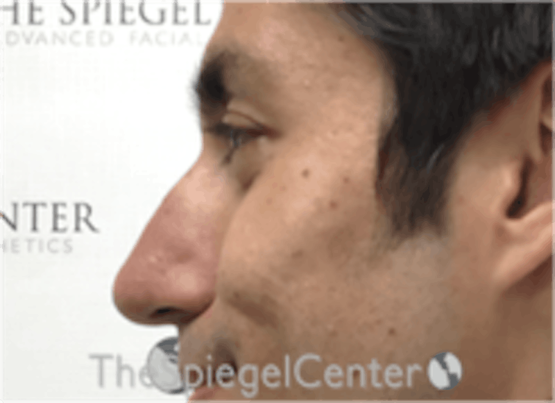 Non-Surgical Rhinoplasty / Nose Filler Before & After Gallery - Patient 157140720 - Image 3