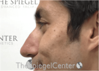 Non-Surgical Rhinoplasty / Nose Filler Before & After Gallery - Patient 157140720 - Image 3