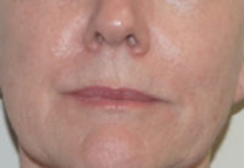 Nasolabial Fold Filler Before & After Gallery - Patient 157140718 - Image 2