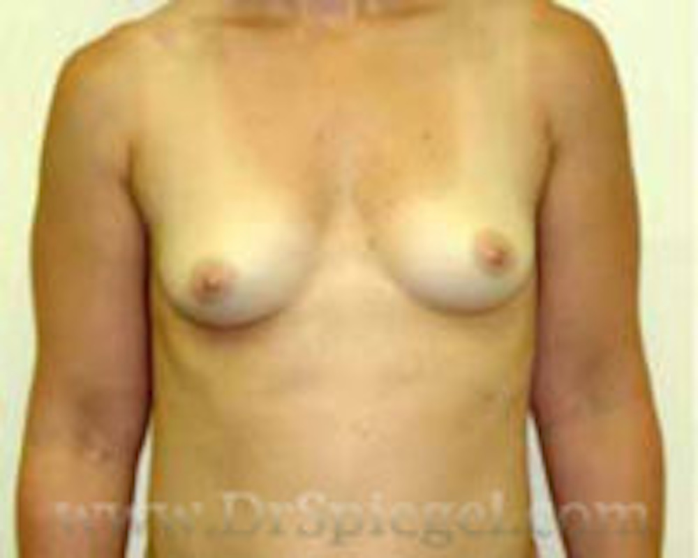 Breast Augmentation